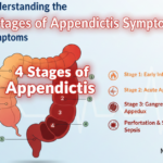 4 Stages of Appendicitis